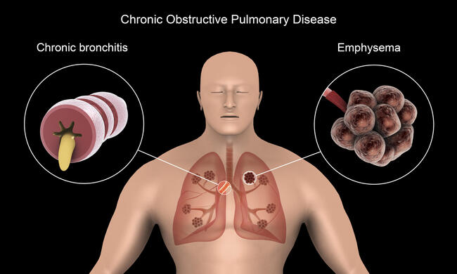 Illustratiion of a human torso showing the lungs inside the chest. Two smaller adjacent illustrations show bronchitis illustrated by puss oozing from a partially blocked bronchial tube and emphysema, represented by swollen discolored air sacs in the lung.